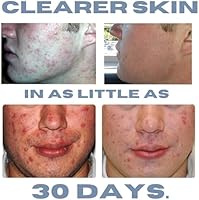 Clearogen 3-Step Acne Treatment Kit — image 3