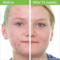 MD Complete Acne Clearing Duo 2.0% Salicylic Acid Cleanser & 4.5% Benzoyl Peroxide Treatment 60 Day Supply — image 6