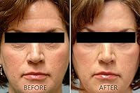 Dr. Brenner Vitamin C Serum 20% with Hyaluronic Acid & Vitamin E, 2-Pack — image 5