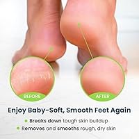 FOOT CURE Exfoliator & Callus Remover Pedicure Set – 4 Piece — image 9