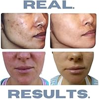 Clearogen 3-Step Acne Treatment Kit — image 2