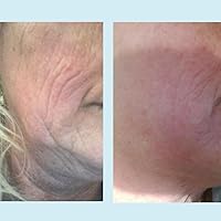 Perfect Image Lactic 50% Gel Peel, 1oz — image 3