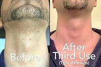 Dual-Shave 2-in-1 Acne Facial Wash + Medicated Shaving Cream 6oz — image 3