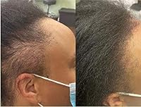 Infinix Black Rice Oil with Tea Tree – 2-Bottle Combo (2 oz Each) — image 4