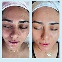 Perfect Image Salicylic Gel Chemical Peel 20% with Green Tea Extract & Tea Tree Oil — image 7