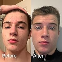 Shield Acne System for Men and Boys - 2 Month Kit — image 3