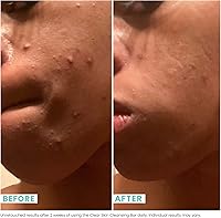 Urban Skin Rx Clear Skin 3-in-1 Daily Treatment Cleansing Bar, 3.7 oz — image 5