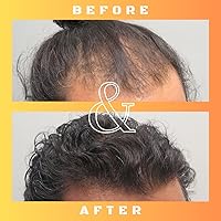 Mane Regain RU58841 5% Solution 30ml — image 5