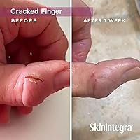 SkinIntegra Rapid Crack Repair Cream 25% Urea, 3oz — image 4