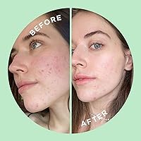 ZitSticka Press Refresh Sheet Masks (5 Sheets) — image 5