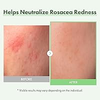 TOSOWOONG Azelaic Acid 10% Face Serum, 33mL — image 4