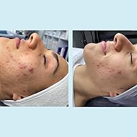 Perfect Image Salicylic Gel Chemical Peel 20% with Green Tea Extract & Tea Tree Oil — image 5