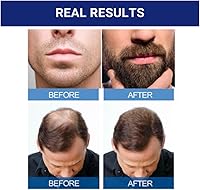 Kirkland Signature Minoxidil 5% Hair Regrowth Treatment for Men 6-Month Supply — image 5