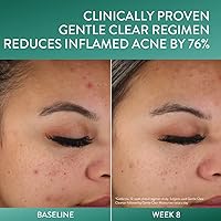 Cetaphil Acne Clearing Kit - Clarifying Acne Cream Cleanser & Mattifying Acne Moisturizer — image 5