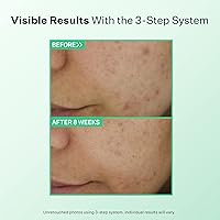 StriVectin Multi Action Clear for Acne and Blemish Prone Skin 7.37oz — image 2