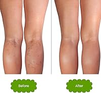 Isabella's Clearly VEIN Varicose Vein Treatment, 1.9oz — image 7