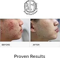 Beauty Facial Extreme Acne Treatment Pads 60 Count — image 7