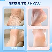 XICOFISS Crack Feet Prevention Stick, Pink+Blue — image 4