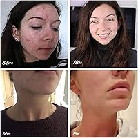 Science of Skin Rescue No. One for Spot, Blemish and Acne Scars — image 7
