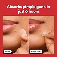 Hero Cosmetics Mighty Patch Original Acne Pimple Patch – 72 Count — image 4