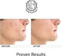 Beauty Facial Extreme Acne Treatment Pads 60 Count — image 8