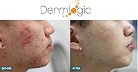 Dermlogic Acne Treatment Pads - 2% Salicylic Acid, Exfoliating, Unscented — image 8