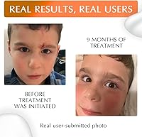 MyNewGel Plus UV Advanced Silicone Scar Gel 15g — image 3