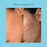 Perfect Image Salicylic Gel Chemical Peel 20% with Green Tea Extract & Tea Tree Oil — image 9