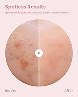 GLAM UP Hydrocolloid Blemish Pimple Zit Patches (180PCS) — image 4