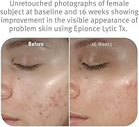 Epionce Lytic Tx 50mL — image 3