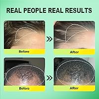 Pipuxi 5% Minoxidil Hair Growth Serum for Men & Women — image 2