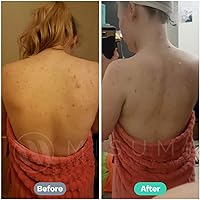 Misumi Acne Body Wash 120mL — image 5