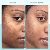 First Aid Beauty Dark Spot Serum, 1 oz — image 3