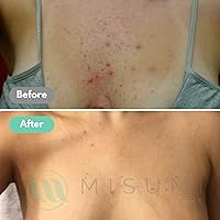 Misumi Acne Body Wash 120mL — image 4