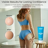 Vanibiss Butt & Thighs Acne Treatment Cream 4oz — image 5