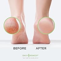 Daily Remedy Foot Callus Remover Gel Set, 8oz — image 6