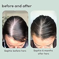 hers Hair Regrowth Treatment Minoxidil 5% Foam 2 Pack — image 6