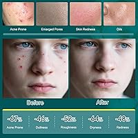 Onkessy Tea Tree Oil Acne Treatment Skin Care Set — image 5