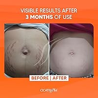 Cicatrissim Stretch Mark Cream 150g — image 3