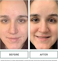 Replenix BP Acne Gel 10% Spot Treatment 2 oz — image 4