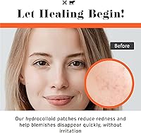 No Bad Stuff Healing Acne Patches 72 CT — image 5