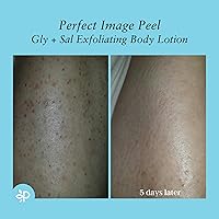 Perfect Image Gly + Sal Exfoliating Body Lotion 8% Glycolic Acid 2% Salicylic Acid 8oz — image 7