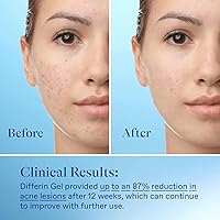 Differin Acne Treatment Gel, 60 Day Supply, 15g (Pack of 2) — image 8