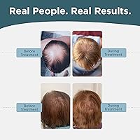 Shapiro MD Minoxidil 5% Topical Solution for Men's Hair Growth - 1 Month Supply — image 7