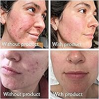 Science of Skin Rescue No. One for Spot, Blemish and Acne Scars — image 6