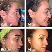 Dr Song Benzoyl Peroxide Wash 10% with Hyaluronic Acid, 8oz — image 2