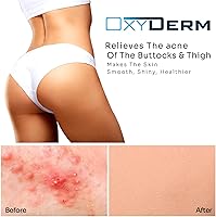OxyDerm Butt & Thigh Acne Treatment Pads — image 3