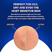 Zocular ZocuZap Acne Face Wipes — image 5