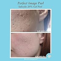 Perfect Image Salicylic Gel Chemical Peel 20% with Green Tea Extract & Tea Tree Oil — image 8