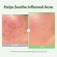 TOSOWOONG Azelaic Acid 10% Face Serum, 33mL — image 3